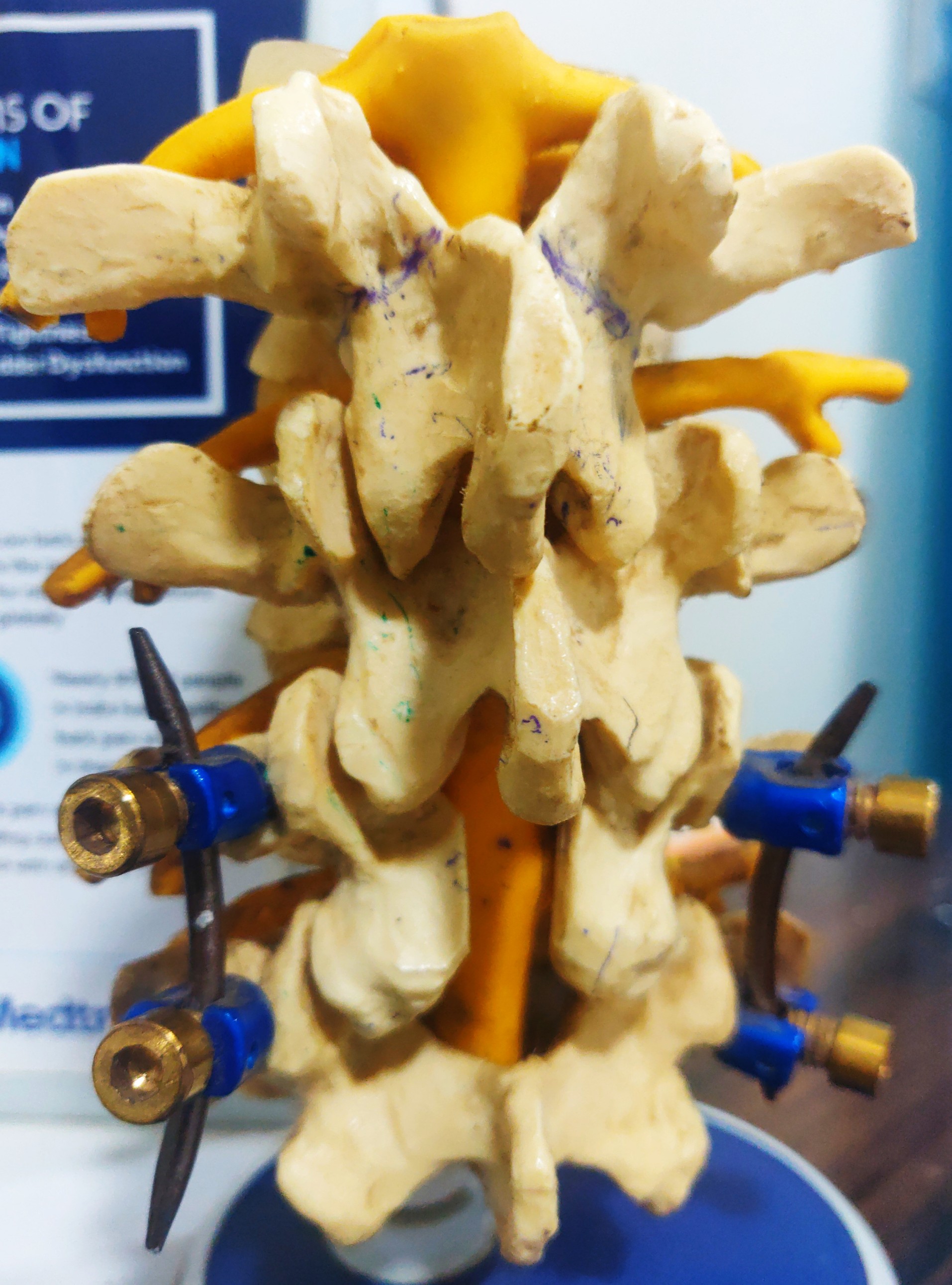Osteoporosis is silent disease of bone. Loss of... main image