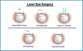 Understanding Lasik Surgery: A Clear Vision Soluti... main image