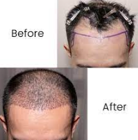 Hair Transplant Treatment! Transform Your Look ... main image