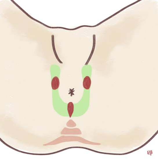 A horseshoe abscess is caused by the lateral sp... main image