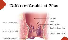 Find Relief with the Top Piles Specialist in Pu... main image