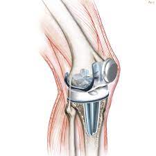 Welton Hospital: Excellence in Knee Replacement... main image