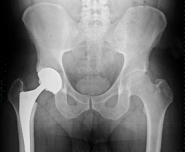 Welton Hospital: The Best Destination for Hip R... main image