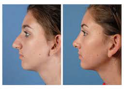 Rhinoplasty  Enhance Your Facial Harmony w... main image