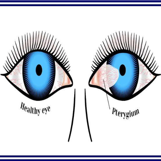 Bid Farewell to Pterygium: Trusted Care at Gree... main image