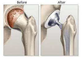 Excellence Redefined in Hip Replacement Surgery... main image