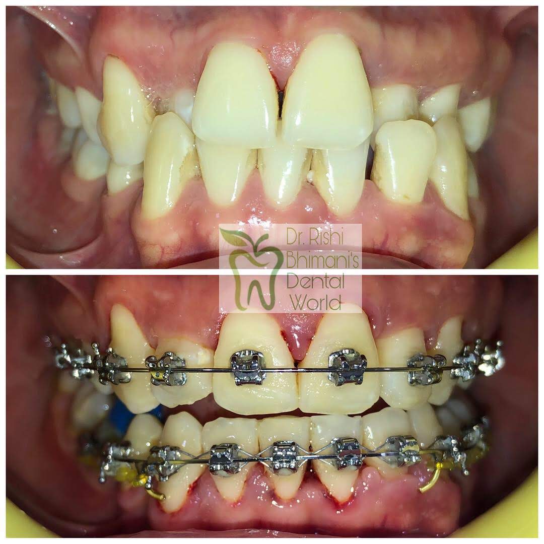Braces are one of the option when it comes to s... main image