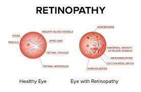 Act Now: Protect Your Vision from Hypertensive ... main image