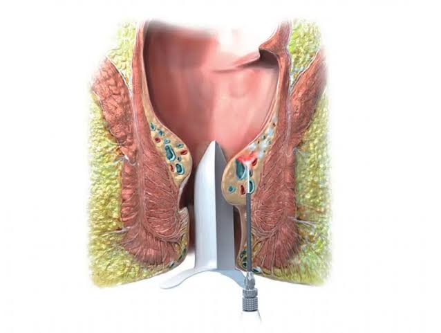 Laser haemorrhoidoplasty is a minimally invasiv... main image