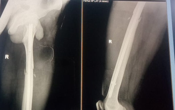 #Integritysuperspecialityhospital
#fracturetreatme... main image