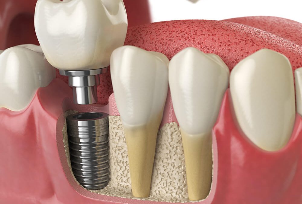 Regain Your Confidence with Dental Implants at ... main image
