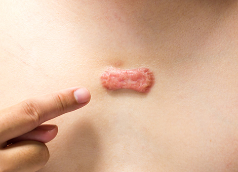 Are you Looking for Keloid Excision Clinic in Raha... main image