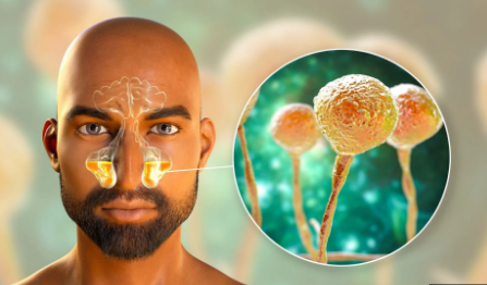 Are you Looking for Mucormycosis Diagnosis And Tre... main image