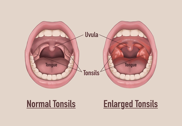 Need Tonsillectomy Treatment Clinic in Rahatani, K... main image