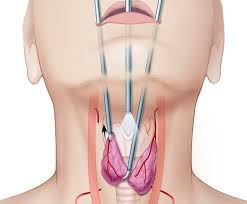 Finding Thyroid Surgery Treatment in Rahatani, Kal... main image