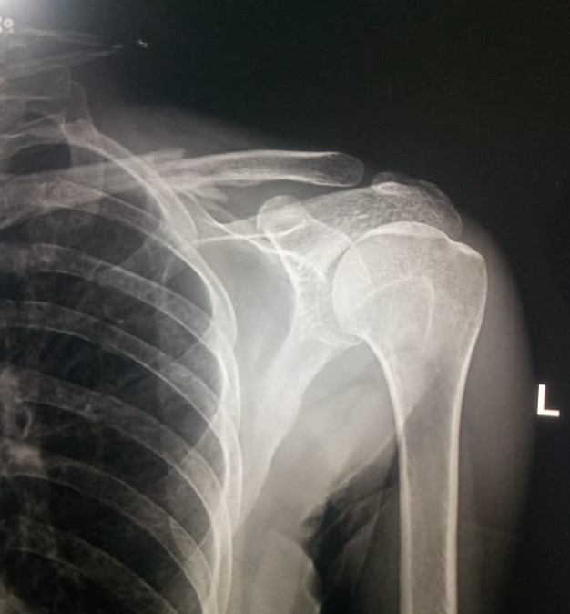 #Integritysuperspecialityhospital
#fractureclavicl... main image