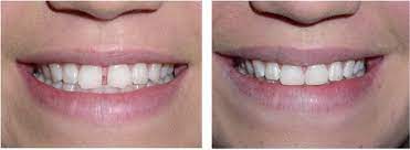 Enhance Your Smile w