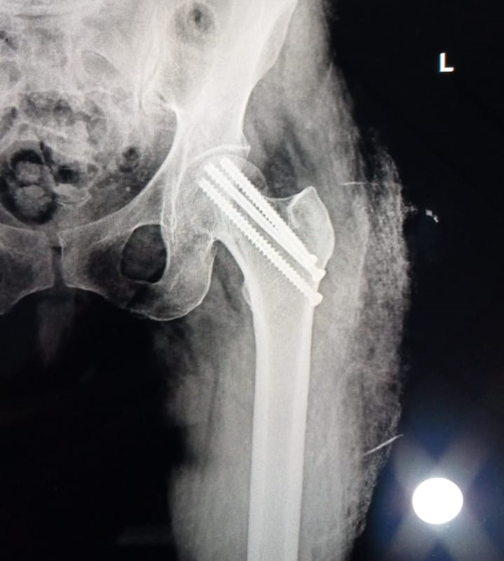 #Integritysuperspecialityhospital
#fractureoperati... main image