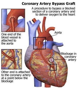 Heart Disease Treatment
Without Bypass Surgery ... main image