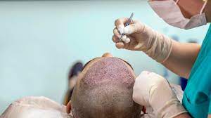 Expert Hair Transplant Treatment in Jaipur Medi... main image