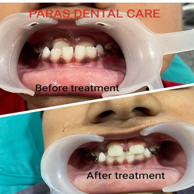 Early class III correction done by braces treat... main image