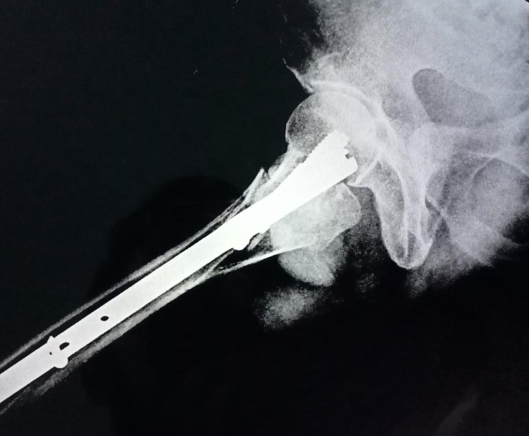 #Integritysuperspecialityhospital
#fracturetreatme... main image