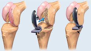 Cutting-Edge Joint Replacement Solutions at Medino... main image