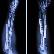 Trauma and Orthopedic Care at Kothrud Hospital: Re... main image