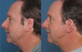 Reshape Your Confidence with Ear Reconstruction... main image