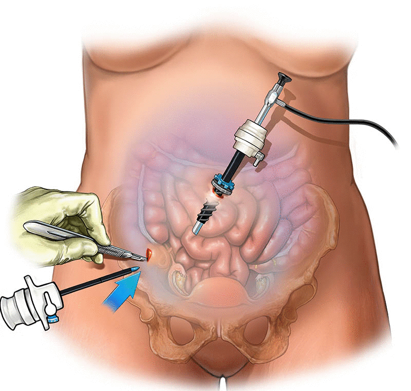Surgery & Laparoscopy at Kothrud Hospital: Adv... main image