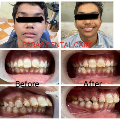 Protruded teeth correction by Orthodontic or br... main image