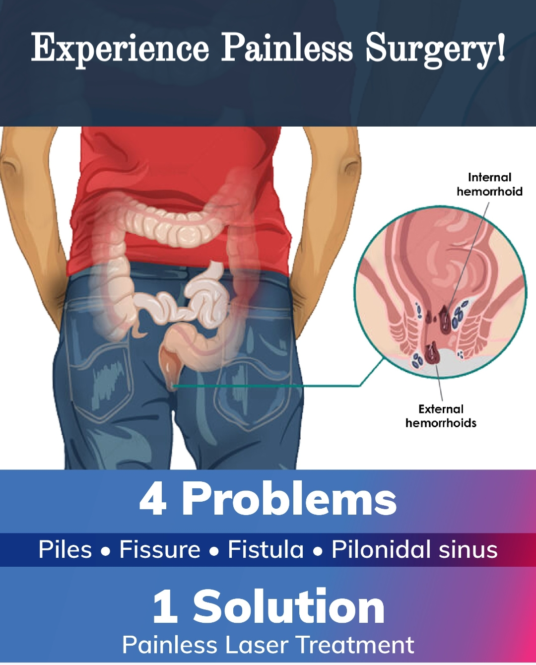 Painless Surgery For Piles...



In the Laser t... main image