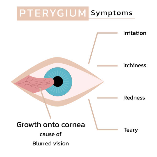 Pterygium Treatment: Unveiling Clearer, Healthi... main image