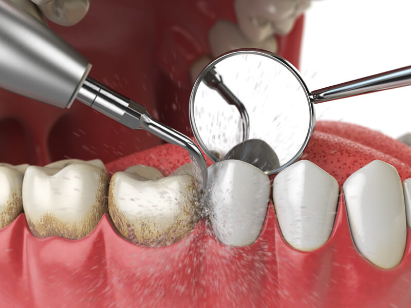 Teeth Scaling | bb.whwalumina.com