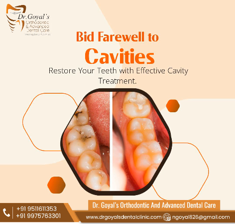 Best Dental Clinic in Wakad | Cavities are hole... main image