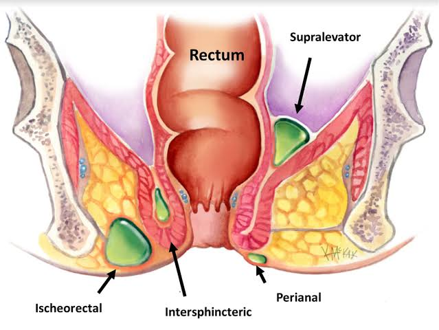 Superficial abscesses (subcutaneous, submucosal... main image