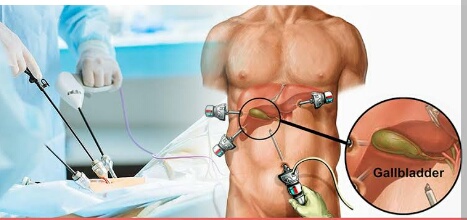 GET BEST GALL BLADER TREATMENT SERVICES WITH WE... main image
