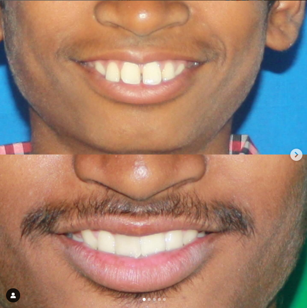 Correction of forwardly placed teeth, as it was... main image