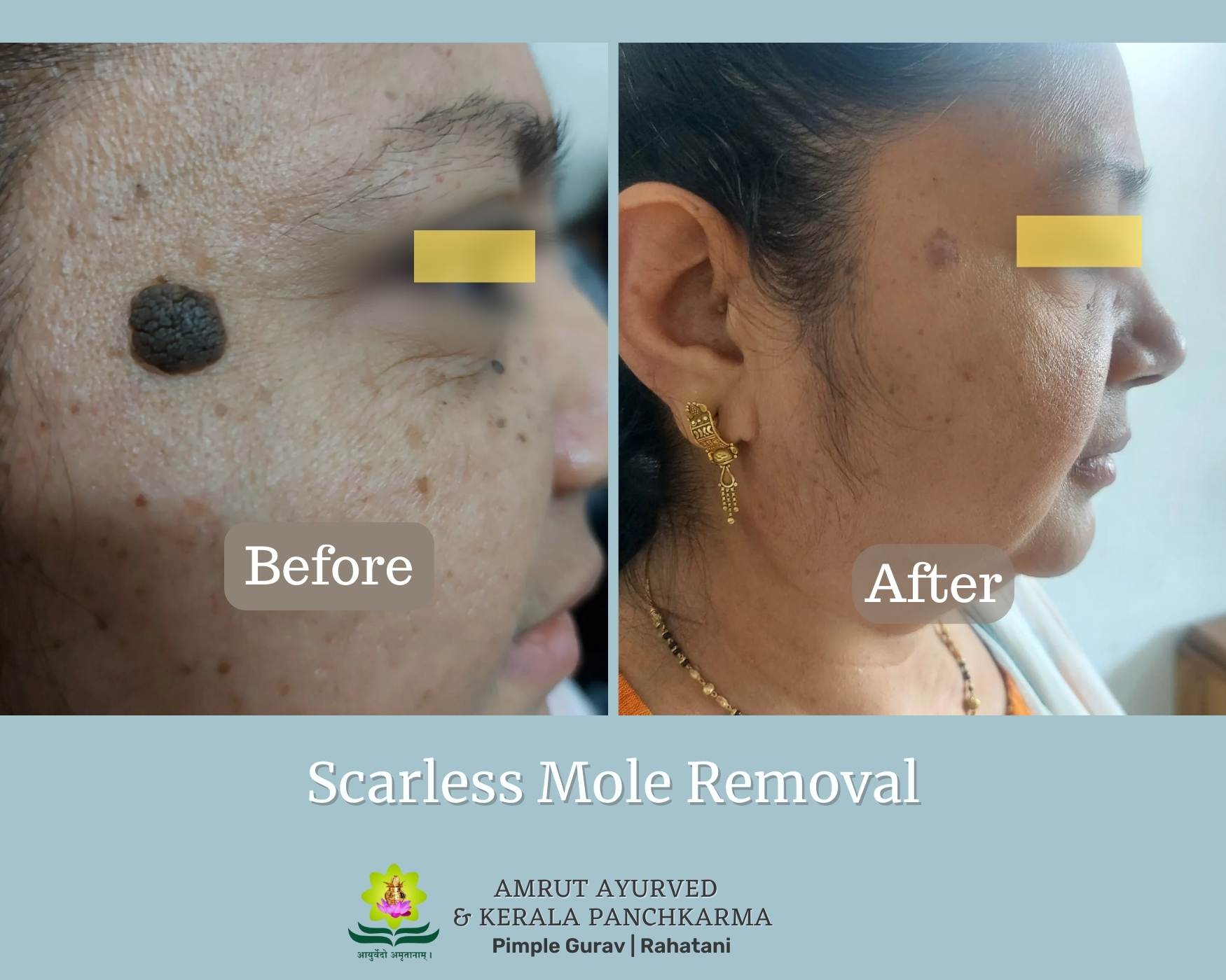Painless Mole removal main image
