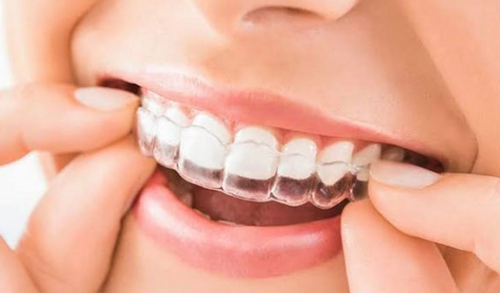 💎Clear aligners have seen a surge in popularity... main image