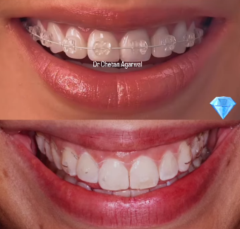 💎Fixed braces or aligners to align your teeth, ... main image