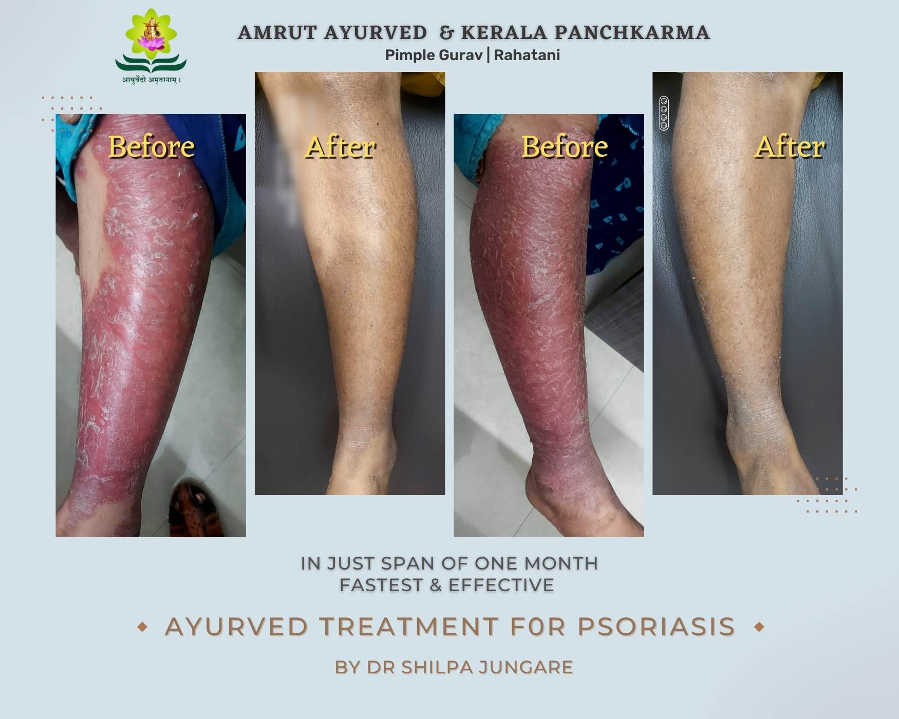 Psoriasis is a skin condition that typically affec... main image