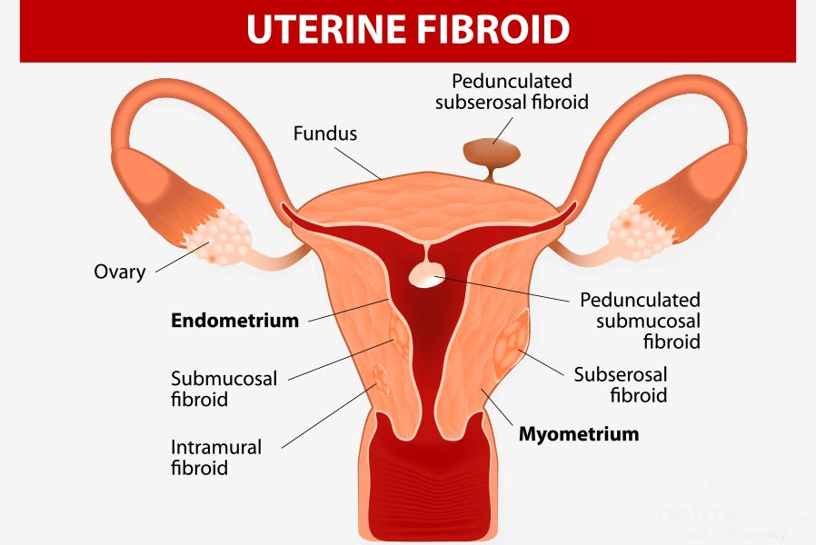 Fibroids, also known as uterine fibroids or lei... main image