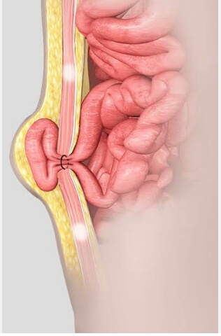 get best hernia treatment services with well kn... main image