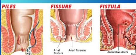 if you are seeking for anal fissure treatment s... main image