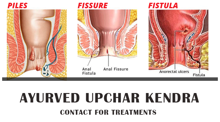 Treatment For Piles, Fistula, Fissure  
30 + Ay... main image