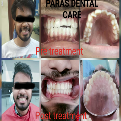Smile correction done with Orthodontics (braces... main image