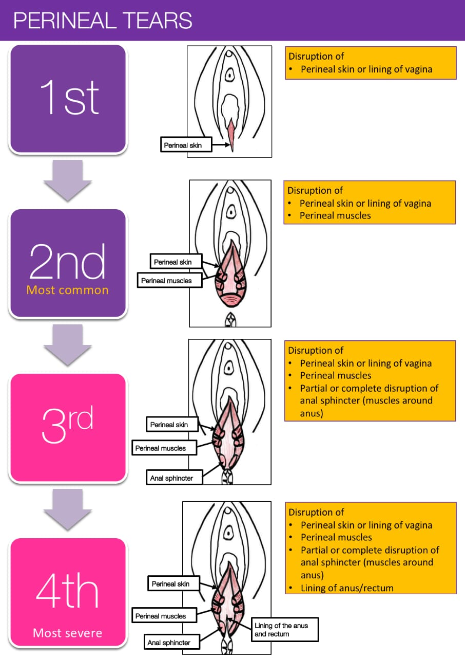 What is a perineal tear?

A vaginal tear happen... main image