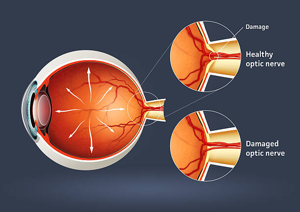 Understanding Detached Retina Treatment Detache... main image