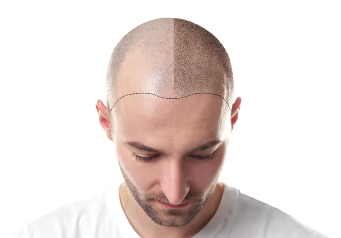 Hair transplant
A hair transplant is a surgica... main image